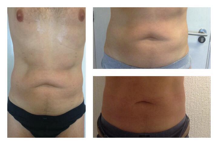 2 Sessions of Cryolipolysis and 6 Sessions of Radio Frequency
