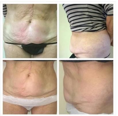 Before & After a course of 3D- lipo