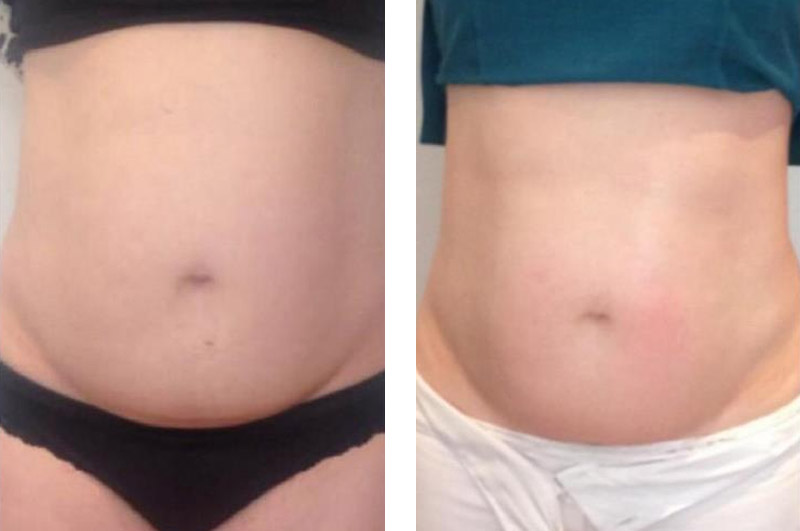 Cavitation Before & After