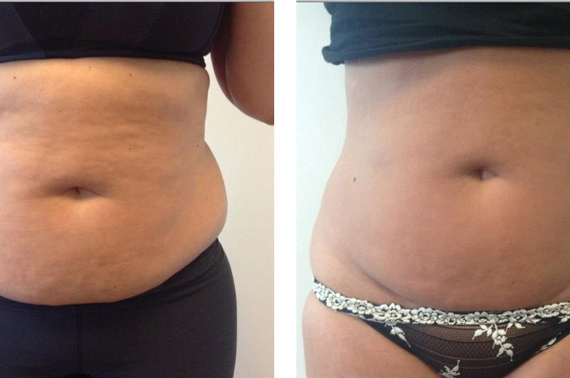 Cryolipolysis Before & After