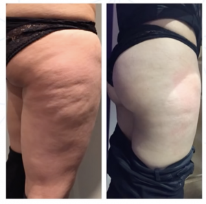 Cellulite reduction after 4 treatments of cavitation