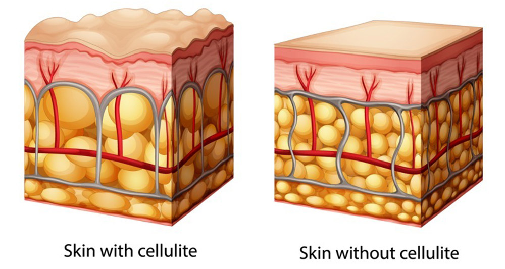Cellulite Skin